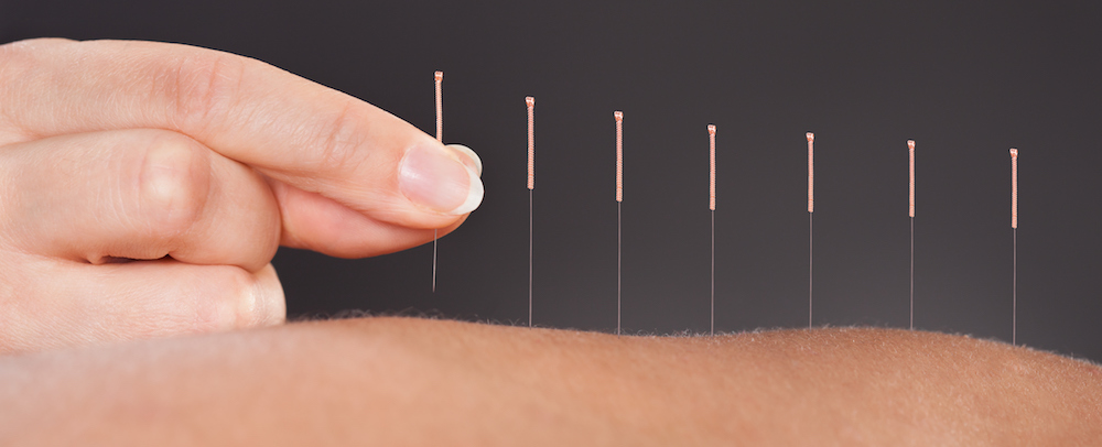 Photo of typical acupuncture treatment that AcuVanture provides in Haddonfield, NJ.